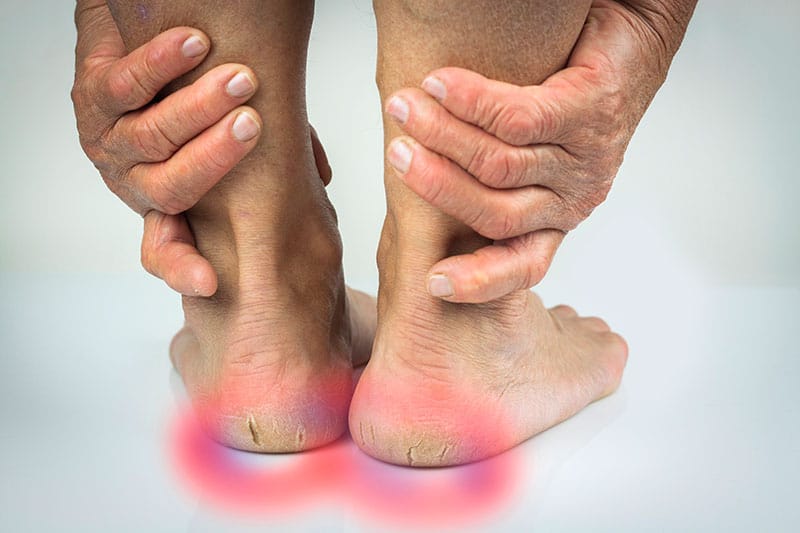 What Causes Cracked Heels? - Walkrite 
